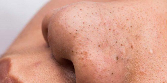 6 ترفند برای خلاص شدن از شر دانه های سرسیاه