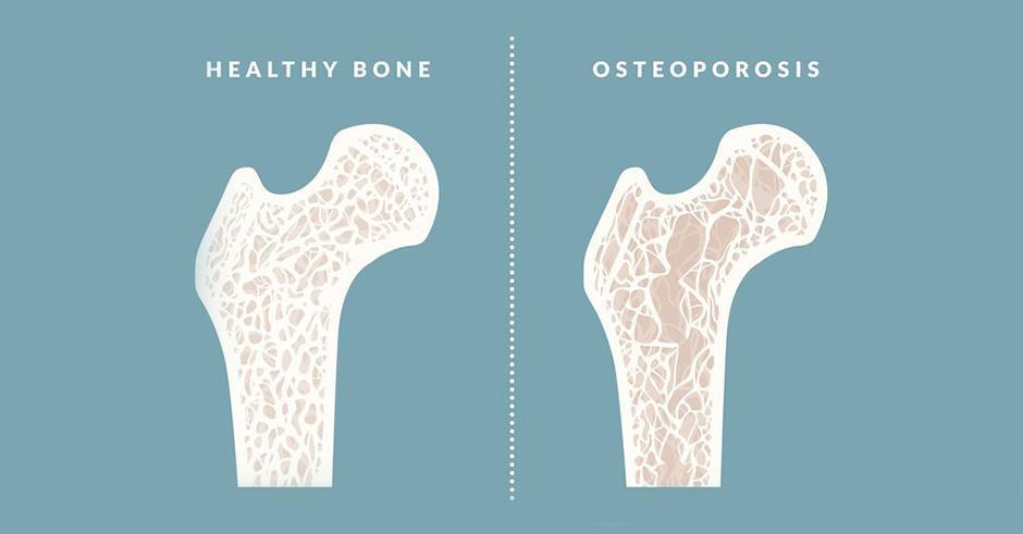 با علائم پوکی استخوان آشنا شوید