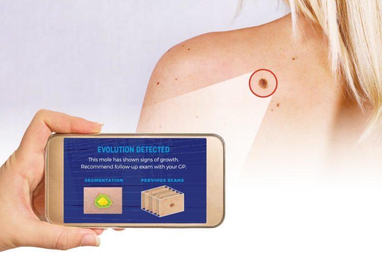 تشخیص سرطان پوست با تلفن همراه