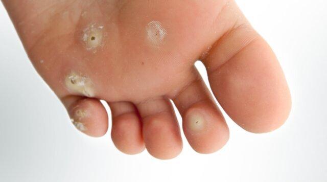 کاهش 10 برابری درمان زخم پای دیابتی ها در مرکز دیابت یزد