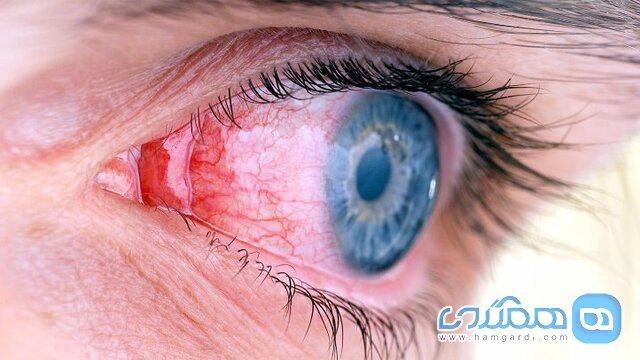 آسیبی که سیگار به چشم ها می زند