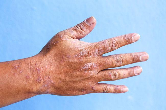 با بثورات پوستی در تابستان چه کنیم؟ با بثورات پوستی در تابستان چه کنیم؟