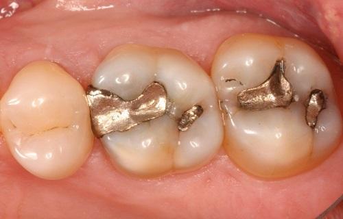 ماده پرکننده دندانی که سرطان به جانتان می اندازد، بیش از 5 دندان پر شده با آمالگام در دهان خطرناک است