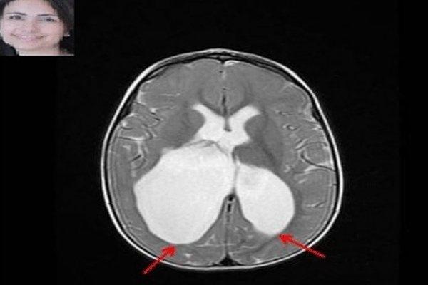 کشف عامل ژنتیک در فلج مغزی توسط یک محقق ایرانی