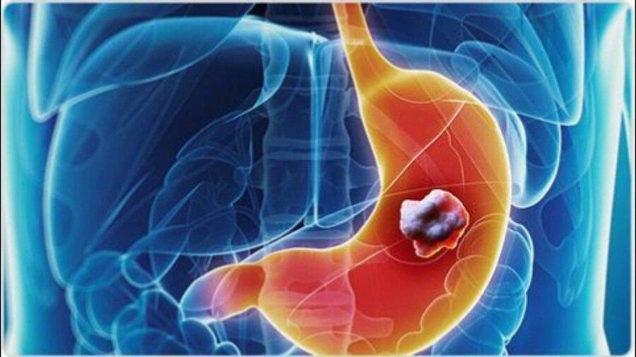 سرطان معده در کدام استان های ایران شیوع بالایی دارد؟