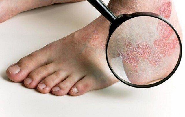 اگزما، شایع ترین بیماری فصل پاییز