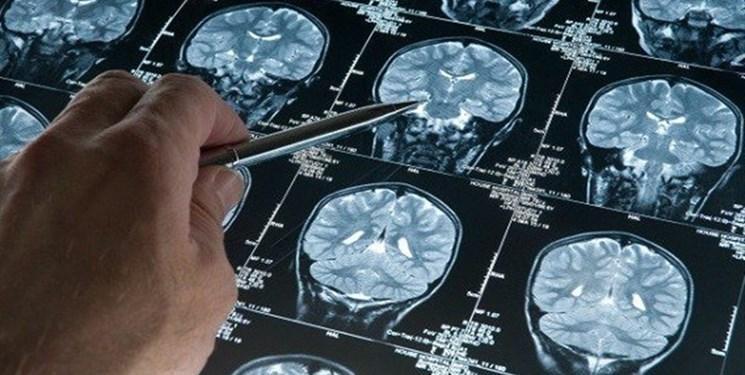 کشف انواع جدید اسکیزوفرنی با اسکن مغز