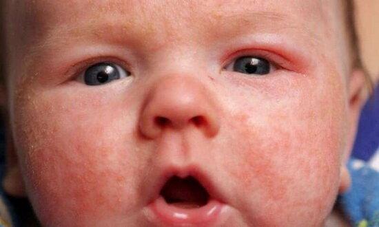 نوزادان در برابر سرخک مصون نیستند