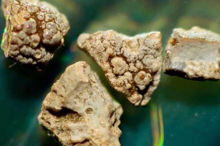 از بین بردن سنگ کلیه با یاری امواج فراصوت