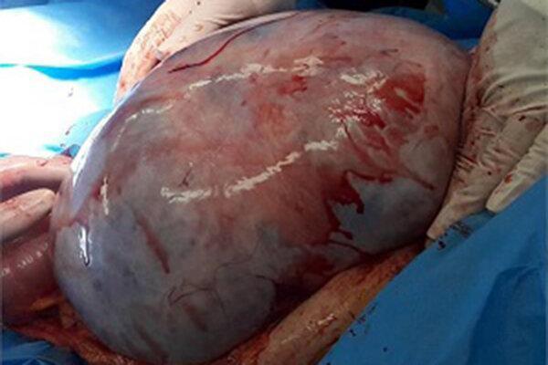 خارج کردن توده 22 کیلوگرمی از شکم یک بیمار