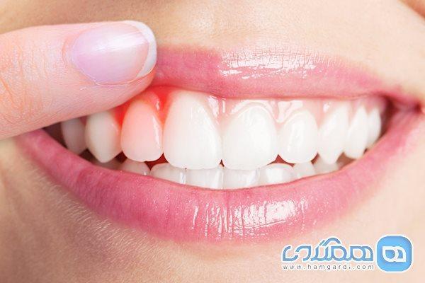 5 روش طبیعی برای تقویت لثه 5 روش طبیعی برای تقویت لثه