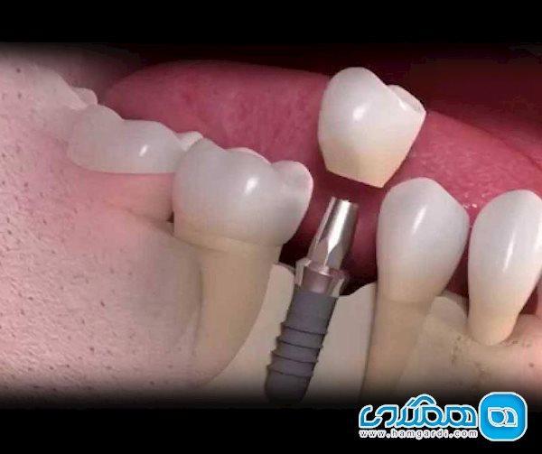 چگونه ایمپلنت و دندان های مصنوعی را تمیز نگه داریم؟ چگونه ایمپلنت و دندان های مصنوعی را تمیز نگه داریم؟
