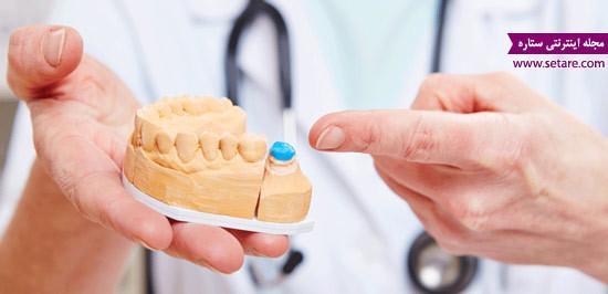 هزینه و قیمت روکش دندان چقدر است؟ هزینه و قیمت روکش دندان چقدر است؟