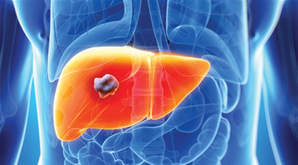 6 وضعیتی که شما را در معرض سرطان کبد قرار می دهد