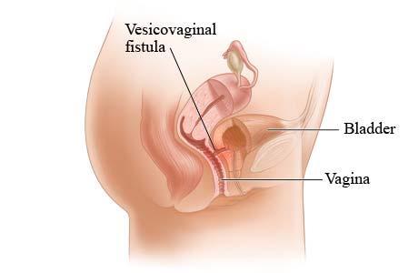 فیستول واژن چیست؟