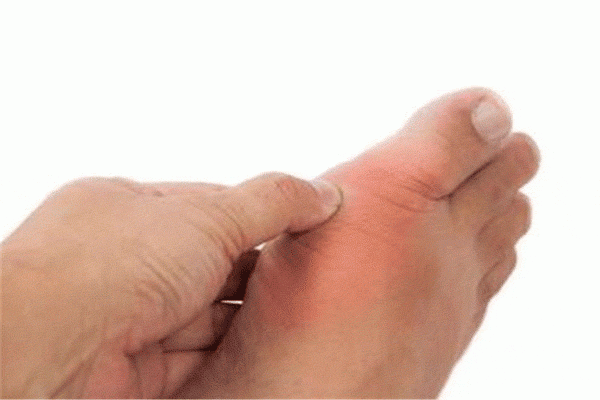 درمان نقرس با رژیم های گیاهی و طب سنتی