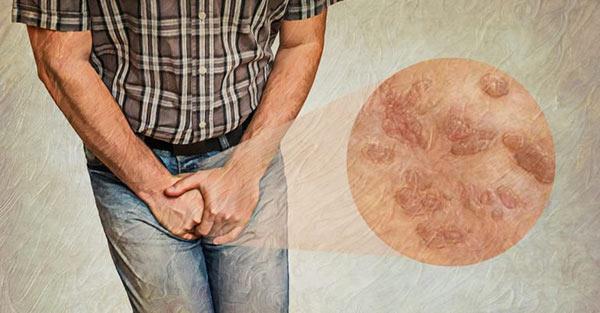 بررسی راه های تشخیص زگیل تناسلی زنان