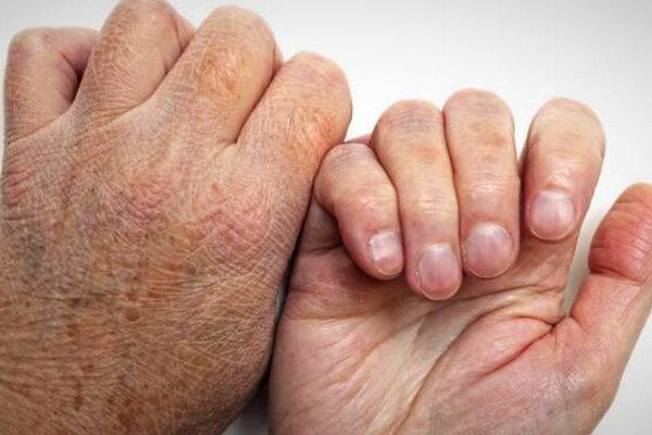 95 درصد مردم هرگز جذام نمی گیرند، عمده ترین نشانه بیماری