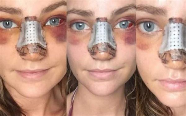 جراحی بینی چه عوارضی دارد؟