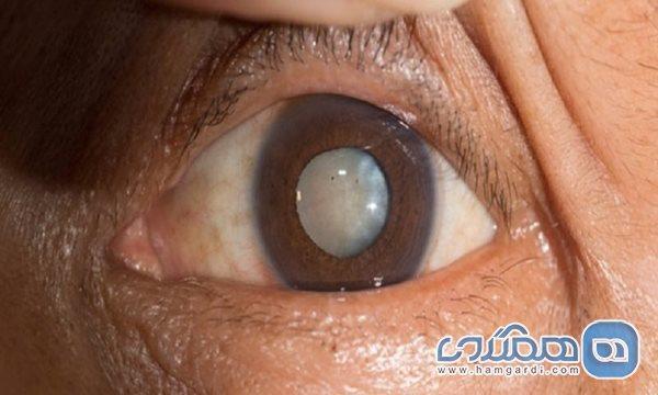 آب سیاه و آب مروارید هیچ شباهتی با یکدیگر ندارند