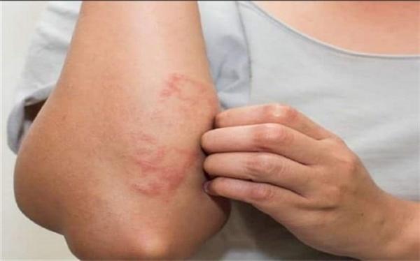 9 ماده غذایی که باعث خارش می شود