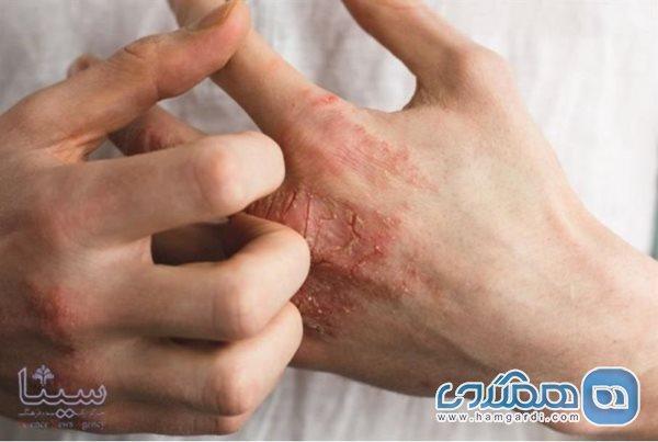 ترکیب حساسیت فصلی و استفاده دائم از ضدعفونی کننده ها