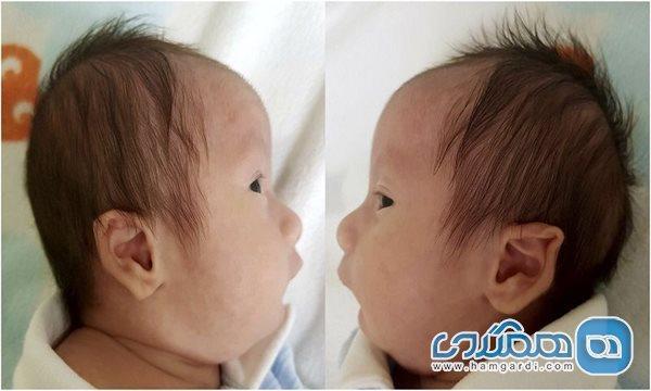 سندروم پیررابین چگونه درمان می گردد؟
