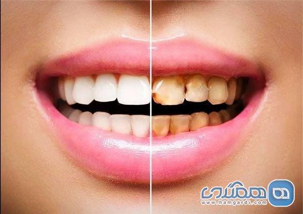 نقص مینای دندان چیست؟ نقص مینای دندان چیست؟