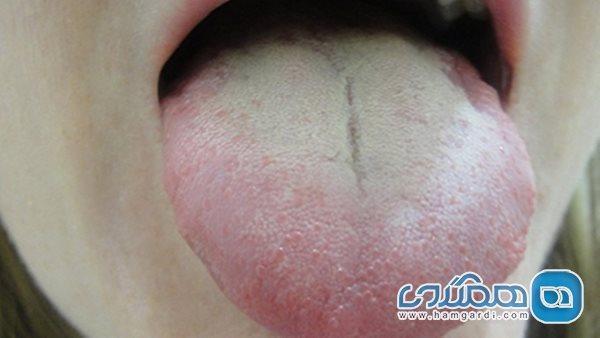 سفید شدن زبان زنگ خطر این بیماری هاست سفید شدن زبان زنگ خطر این بیماری هاست