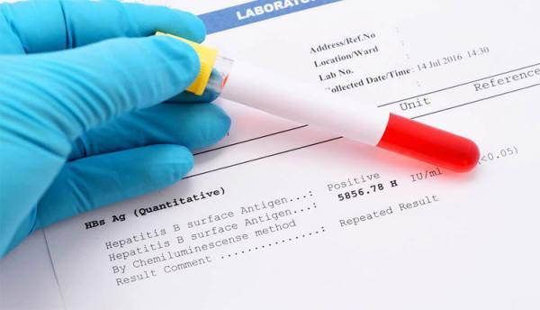 انواع آزمایش هپاتیت ب و تفسیر آنها