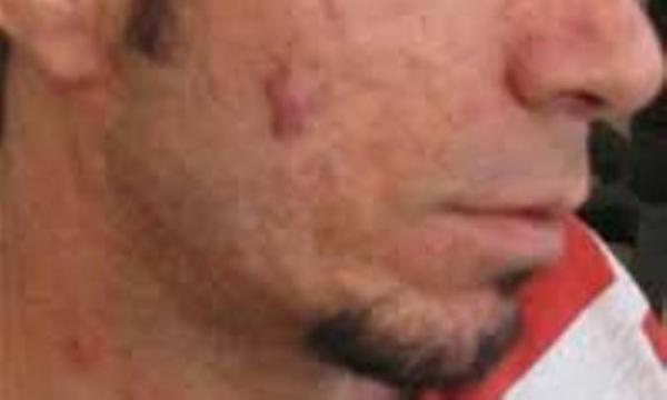 کرم سفیدکننده برای جای زخم آکنه