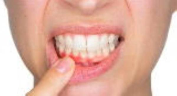 التهاب لثه چیست و علائم آن چه می باشد؟ التهاب لثه چیست و علائم آن چه می باشد؟