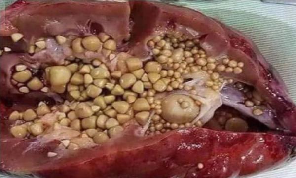 سنگ کلیه و راه درمان خانگی آن سنگ کلیه و راه درمان خانگی آن